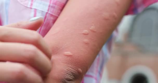 Укушенные комарами летом — стоковое видео