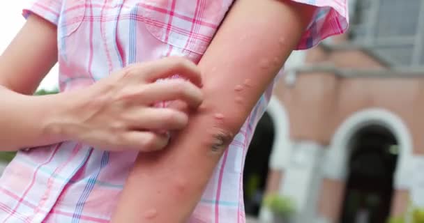 Nyáron szúnyog csípte meg. — Stock videók