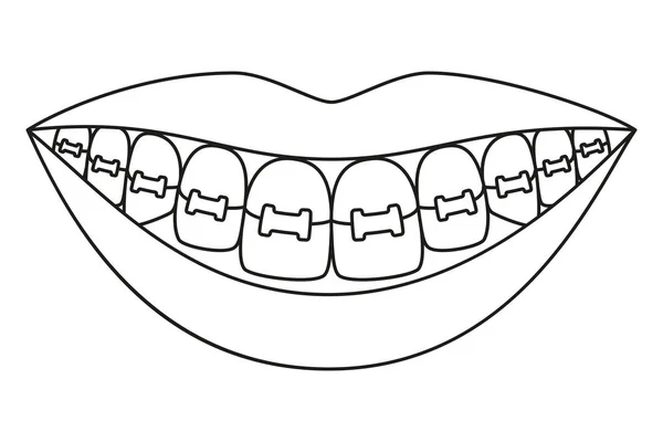 Line Art schwarz-weiß gesundes Lächeln in Zahnspange — Stockvektor