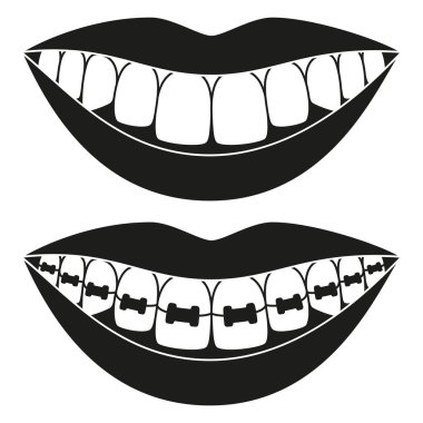 Siyah ve beyaz dişler öğeleri siluet hizalama. Önce ve sonra dişlek gülümseme ile diş teli. Güzel gülümseme kavramı ulaşmak. Dentalcare vektör çizim simgesini, etiket, rozet dekorasyon için