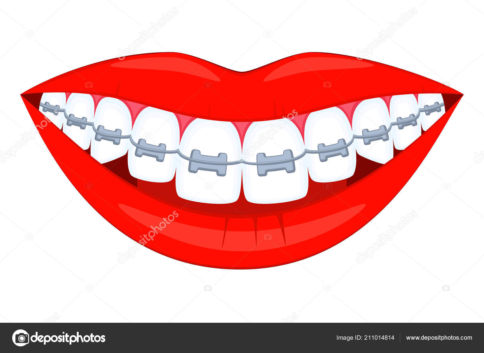 Ortodoncia brackets imágenes de stock de arte vectorial | Depositphotos Ortodoncia brackets imágenes de stock de arte vectorial | Depositphotos