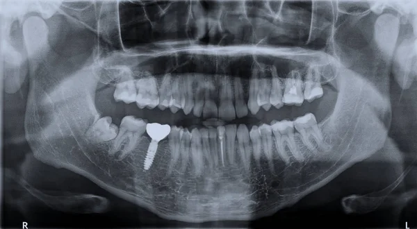 Tek diş implantı ile yetişkin panoramik siyah beyaz görüntü diş röntgeni. Roentgen dişler üst ve alt çene. Dijital resmin negatif çekimi