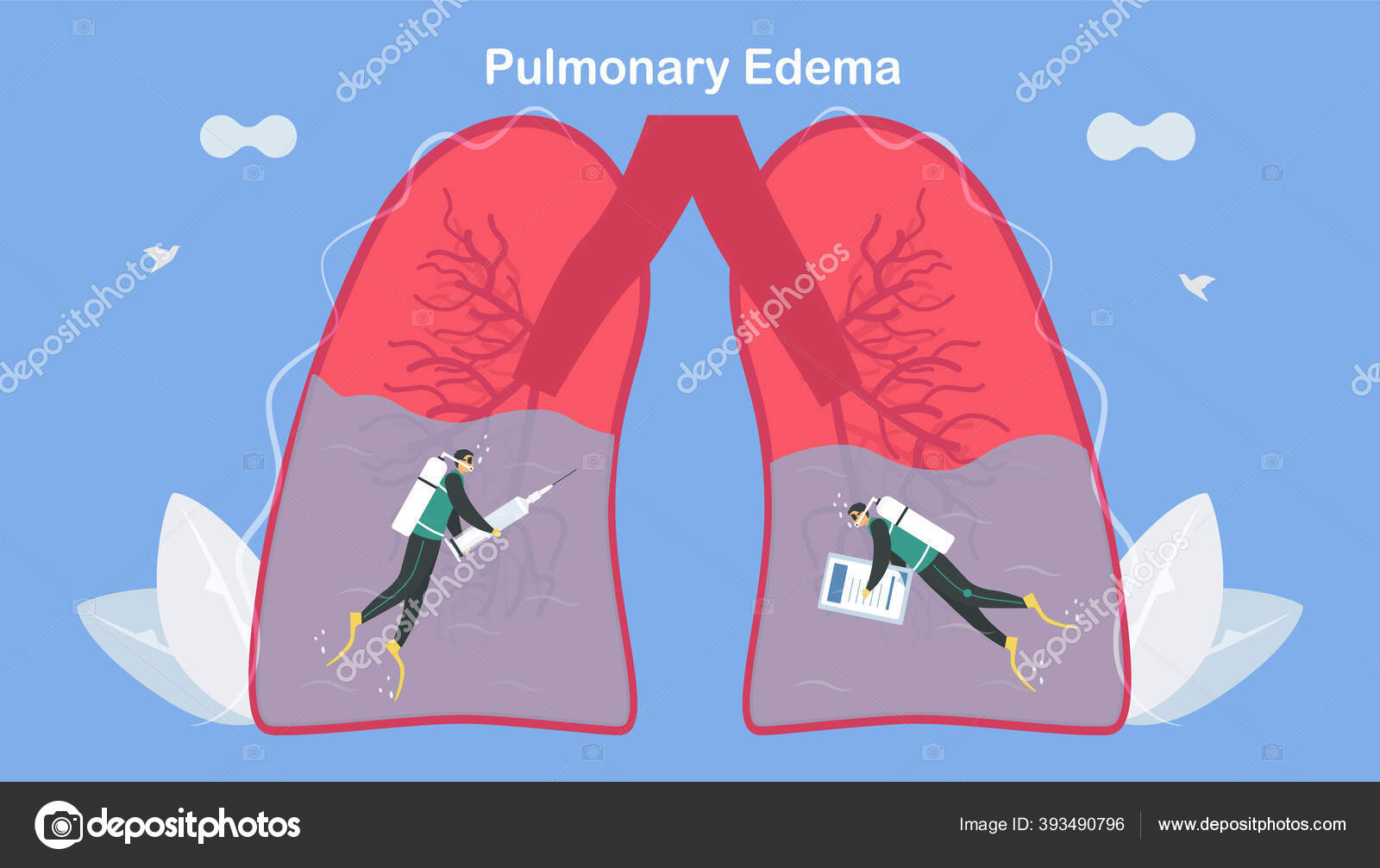 Pulmonary Edema Symptom Lungs Fill Fluid Treatment Diagnostic Body