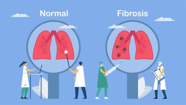 Pulmonary fibrosis is a part of restrictive lung disease. Lung tissue becomes damaged and scarred. Comparison of normal and bad symptom, respectively. Pulmonology vector illustration. clipart
