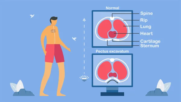 Pectus Excavatum Структурная Деформация Передней Грудной Стенки Грудная Клетка Грудная — стоковый вектор