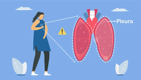 Pleurésie Est Une Plèvre Qui Sépare Les Poumons Paroi Thoracique — Image vectorielle