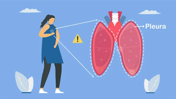 Pleuresía Una Pleura Que Separa Los Pulmones Pared Torácica Inflama — Archivo Imágenes Vectoriales