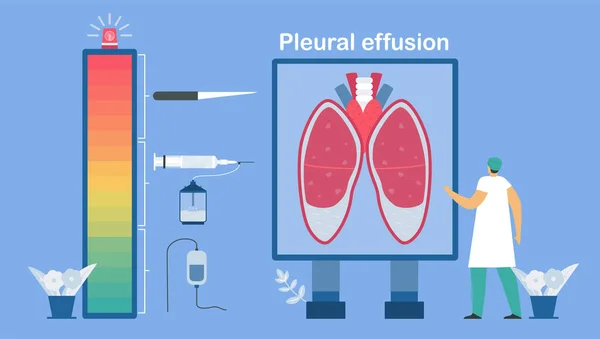 Niveau Des Traitements Épanchement Pleural Est Collecte Excès Liquide Entre — Image vectorielle