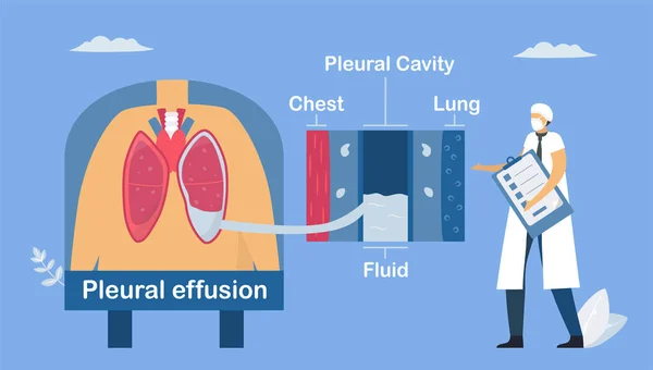 Épanchement Pleural Est Collecte Excès Liquide Entre Les Couches Plèvre — Image vectorielle