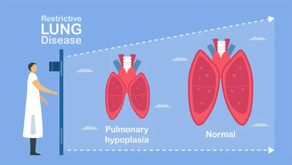 肺低形成症は肺の不完全なものである これは アルベオーリの低サイズを引き起こす 肺疾患に関する肺腫瘍学 — ストックベクタ