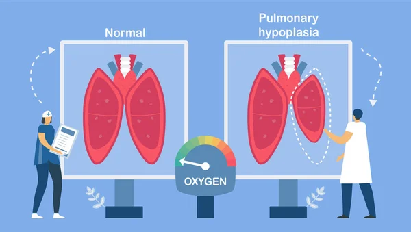 Hipoplasia Pulmonar Está Incompleta Dos Pulmões Causa Baixo Tamanho Dos — Vetor de Stock