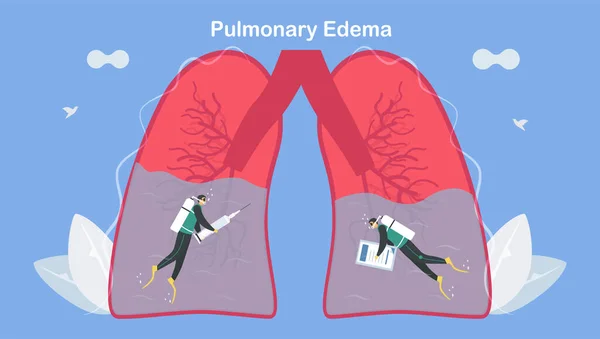 肺水肿是肺充满液体的症状 治疗和诊断 身体挣扎着获取足够的氧气直到呼吸急促 — 图库矢量图片