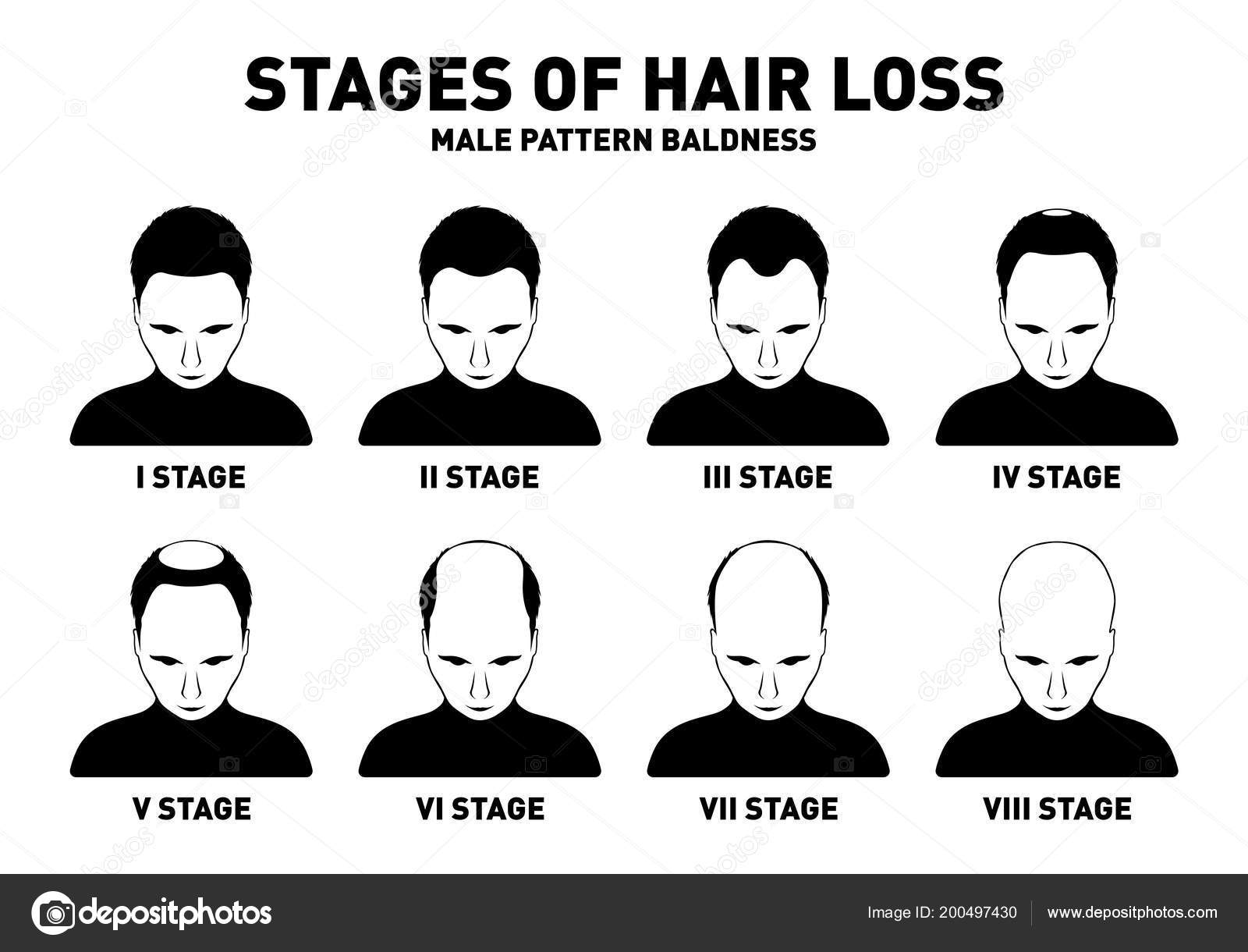 Hair Loss Stages Types Male Hair Loss Male Pattern Baldness — Stock