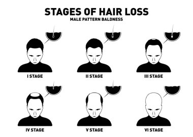 Hair loss. Stages and types of male hair loss. Male pattern baldness. Head of hairy and bald man in top view. Alopecia concept. Vector clipart