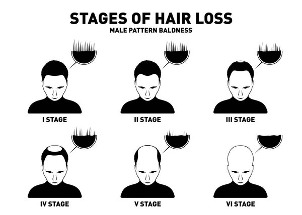 Hair loss. Stages and types of male hair loss. Male pattern baldness. Head of hairy and bald man in top view. Alopecia concept. Vector