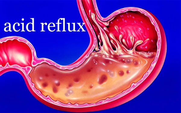 Acid reflux written blue background