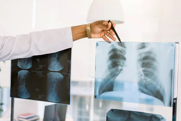 Travailleur de la santé afro-américain aux rayons X. Image recadrée de la main du médecin africain masculin pointant vers l'image radiologique de la poitrine du patient — Photo