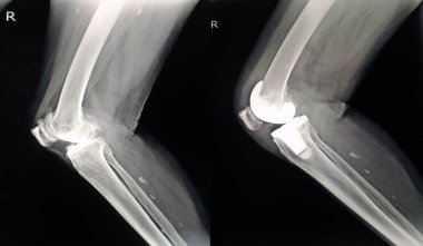 x-ışını Haritayı diz eklem diz Ostoearthritis yan görünüm/x-x-ray Haritayı diz eklem replasmanı
