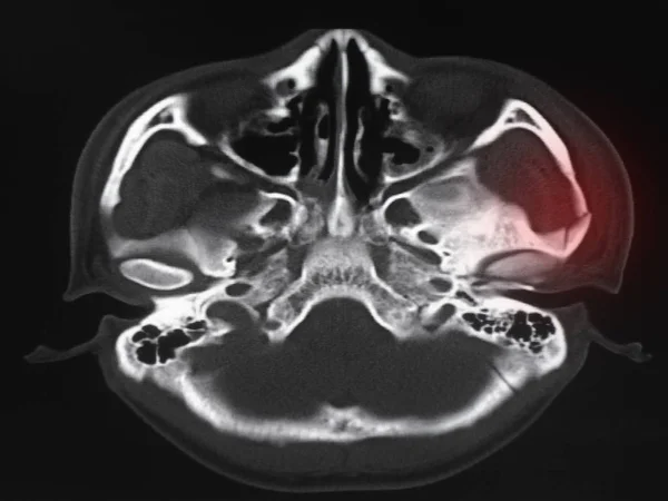 Brain Showing Fracture Zygoma — Stock Photo, Image