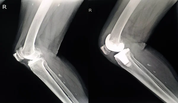 Ray Bizonyítani Közös Térd Ostoearthritis Side View Betű Fénysugár Térkép — Stock Fotó