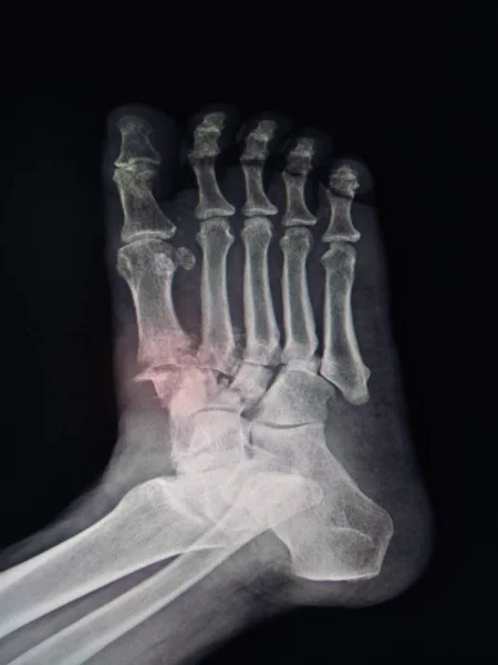 X-ray Foot  Finidngs Fracture base of 1st-2nd metatarsal bone.color mark,too soft and blurry image.