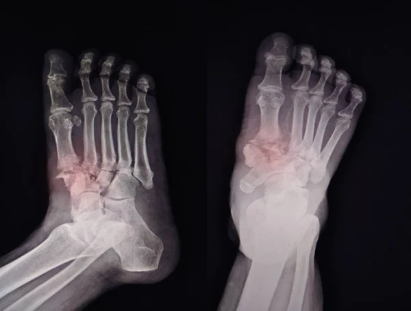 Ray Foot Finidngs Fracture Base 1St 2Nd Metatarsal Bone — Stock Photo, Image