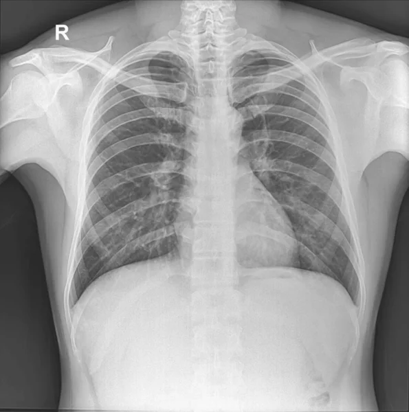 Radiografía Tórax Erguida Muestra Tórax Humano Normal — Foto de Stock