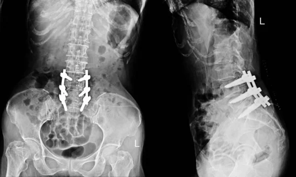 Рентген Позвоночника Шоу После Операции Laminectomy Пластинчатым Винтом — стоковое фото