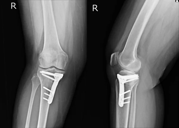 X-ray Knee show post operation right knee with plate screw