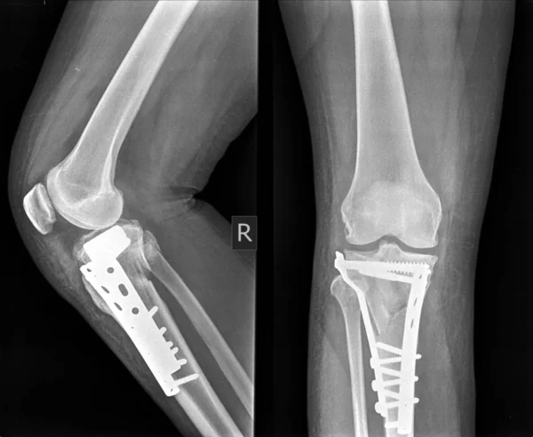 Ray Kolana Post Chirurgiczne Płyta Śruba Mocowania Wewnętrznego Tibai Zbyt — Zdjęcie stockowe