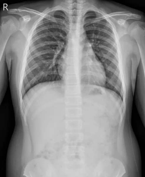 Рентгенівський Знімок Грудей Хлопчик Років Показувати Нормальний Розмір Серця Груди — стокове фото