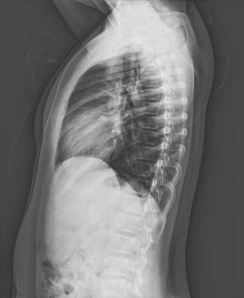Radiographie Thoracique Latérale Garçon Ans Taille Normale Cœur Thorax Osseux — Photo