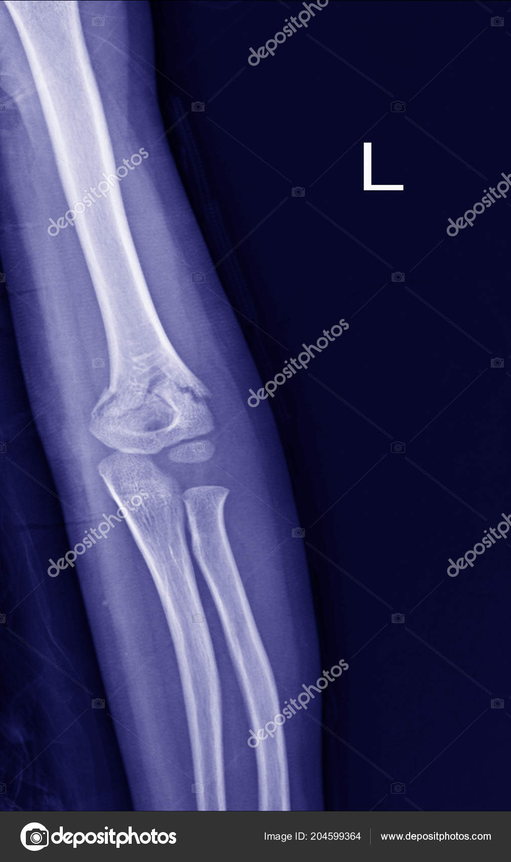 Fractura Cotovelo Raios — Foto © Richmanphoto #204599364, image size:1009x1700