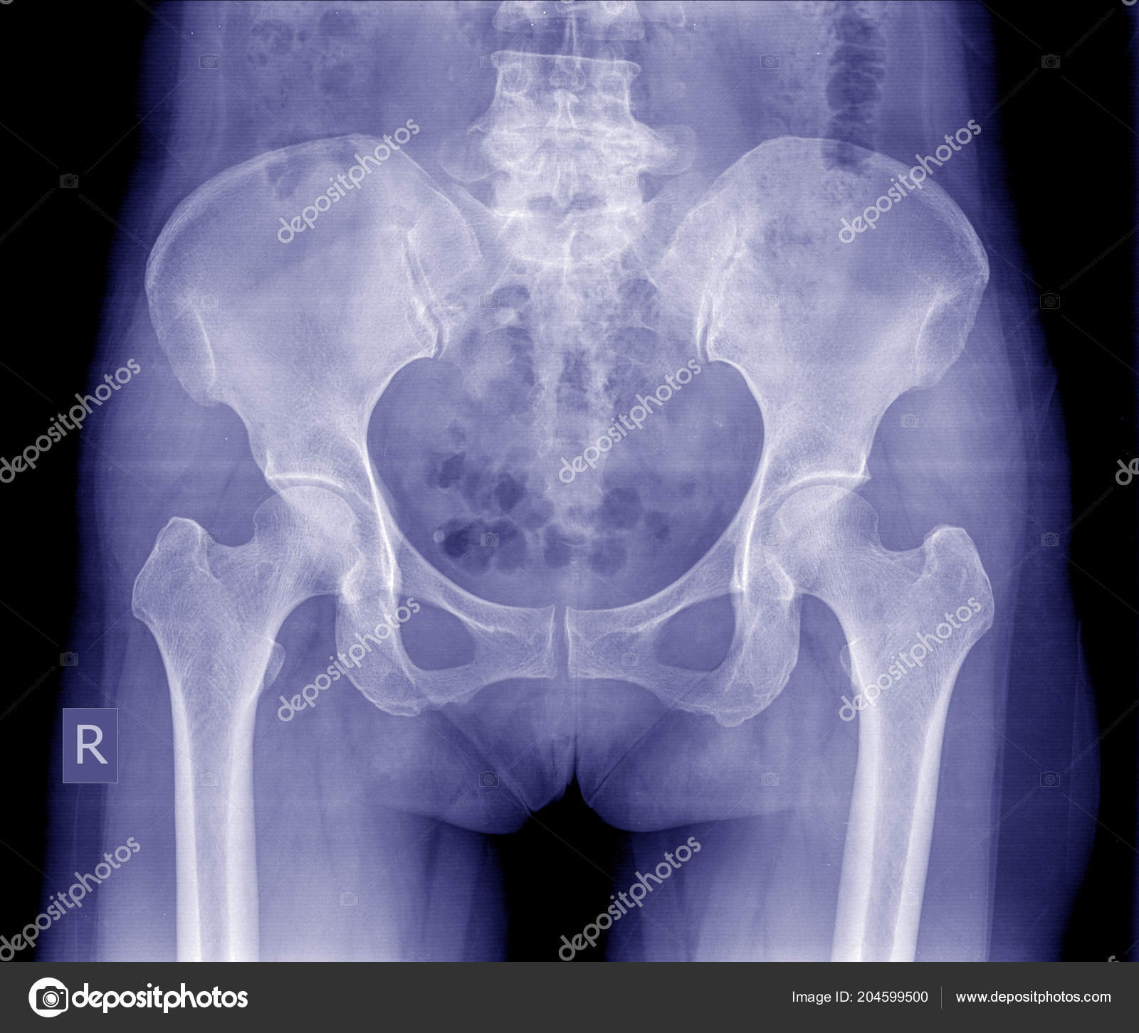 Без видимых патологий. ТБС рентген анатомия. Остеопороз костей таза рентген. Остеопороз тазобедренного сустава рентген. Рентген таза и тазобедренных суставов.