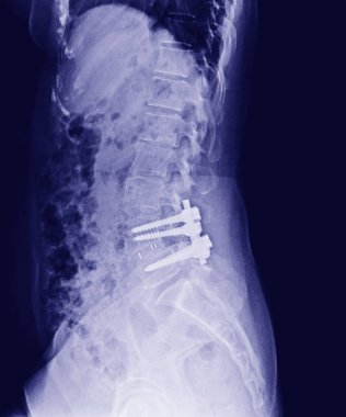 Leğen kemiği ve omurga, yan görünüm sonrası açık redüksiyon Internal fiksasyon ile iç kemik çubuk, plaka ve vida ortopedik cerrah tarafından X-Ray.