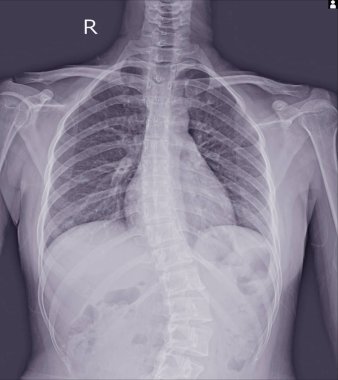 Skolyoz film x-ışını Genç hastada spinal bend göster. Skolyoz hastalığı.
