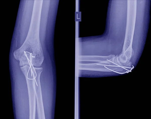 Рентген После Операции Внутренняя Фиксация Перелома Локтя — стоковое фото