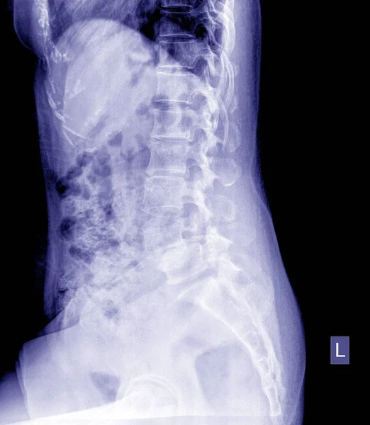 Radiografía Pelvis Columna Vertebral Vista Lateral — Foto de Stock