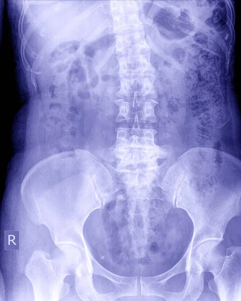 Radiografía Pelvis Columna Vertebral — Foto de Stock