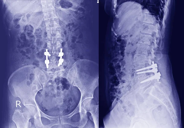 Röntgen Des Beckens Und Der Wirbelsäule Seitenansicht Nach Offener Reduktion — Stockfoto