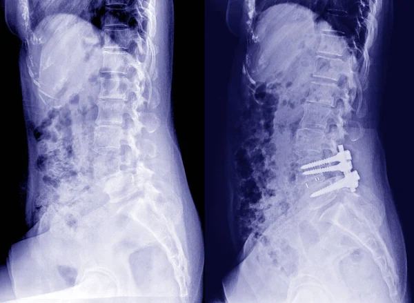 Radiografía Pelvis Columna Vertebral Vista Lateral Post Open Reduction Fijación — Foto de Stock