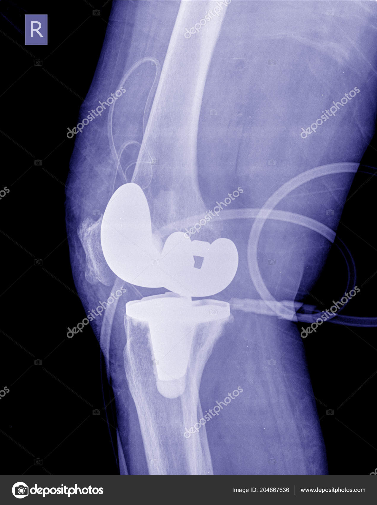 Эндопротез голеностопного сустава. Реабилитация коленного сустава. Покажи замену коленного сустава. Ортез на тазобедренный сустав. Коленный эндопротез зиммер.