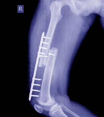 Kırık uyluk kemiği, kırık bacak röntgen resim, x-ışını görüntü kırık bacak (femur) implant plaka ve vida yerinden çıkması ile.