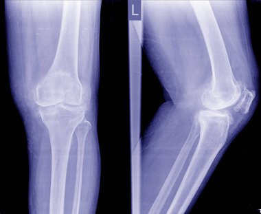 Osteoartrit (Oa) diz. Film x-ışını Apand yanal görünümünü diz göstermek dar ortak alan, osteophyte (teşvik), subchondral skleroz, diz eklem iltihabı.