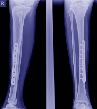 Bacak röntgen görüntü kırık, kırık bacak (tobia) implant plaka ve vida ile görüntüsünü röntgeni.