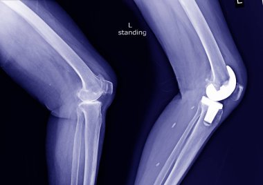 Knee(Oa) sol osteoartrit x-ışını ve işlem Toplam diz protezi (Tka) görünümü post.