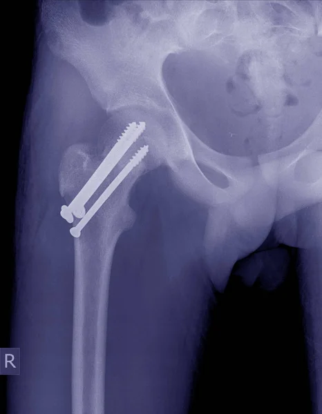 髋部骨折的术后内固定装置 — 图库照片