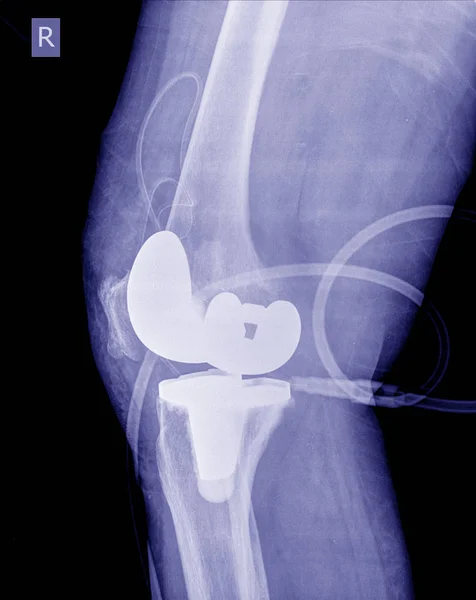 Radiographie Image Post Opération Genou Total Remplacement Genou Droit — Photo