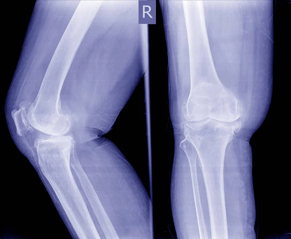 Остеоартроз Коліна Плівковий Рентгенівський Передній Задній Бічний Вигляд Коліна Показують — стокове фото