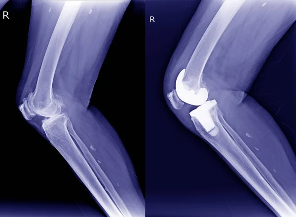 X-ray Right Osteoarthritis of knee(OA) and post operation Total Knee Arthroplasty( TKA)view.